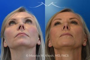 Photo of a patient before and after a procedure. Rhinoplasty for Crooked Nose, Nasal Hump, and Severe Obstruction - This amazing 65 year-old had chronic severe right sided nasal obstruction, deviation of the nose to the left side, and a small nasal hump. Surgery to address her concerns included: open approach rhinoplasty, septoplasty, right sided spreader graft, right sided septum extension graft, and a small right sided alar strut graft. She is delighted with the improved breathing and the straight appearing nasal bridge. 