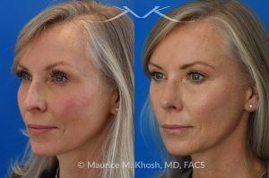 Photo of a patient before and after a procedure. Rhinoplasty for Crooked Nose, Nasal Hump, and Severe Obstruction - This amazing 65 year-old had chronic severe right sided nasal obstruction, deviation of the nose to the left side, and a small nasal hump. Surgery to address her concerns included: open approach rhinoplasty, septoplasty, right sided spreader graft, right sided septum extension graft, and a small right sided alar strut graft. She is delighted with the improved breathing and the straight appearing nasal bridge. 