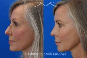 Photo of a patient before and after a procedure. Rhinoplasty for Crooked Nose, Nasal Hump, and Severe Obstruction - This amazing 65 year-old had chronic severe right sided nasal obstruction, deviation of the nose to the left side, and a small nasal hump. Surgery to address her concerns included: open approach rhinoplasty, septoplasty, right sided spreader graft, right sided septum extension graft, and a small right sided alar strut graft. She is delighted with the improved breathing and the straight appearing nasal bridge. 