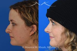 Photo of a patient before and after a procedure. Rhinoplasty to Correct Nasal Hump and Drooping Tip - This amazing 22 year-old was bothered by the droopiness of the tip of her nose and the large nasal hump. We used the open approach to perform septoplasty, dorsal reduction, caudal septum shortening, cephalic trimming, and alar strut grafts. She is delighted with the improved breathing, and loves the new shape of her tip and the bridge of her nose. 