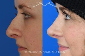 Photo of a patient before and after a procedure. Rhinoplasty to Correct Nasal Hump and Drooping Tip - This amazing 22 year-old was bothered by the droopiness of the tip of her nose and the large nasal hump. We used the open approach to perform septoplasty, dorsal reduction, caudal septum shortening, cephalic trimming, and alar strut grafts. She is delighted with the improved breathing, and loves the new shape of her tip and the bridge of her nose. 