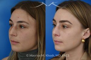 Photo of a patient before and after a procedure. Rhinoplasty to Straighten the Tip and Reduce Nasal Hump - before-and-after composite photo.