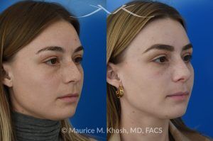 Photo of a patient before and after a procedure. Rhinoplasty to Straighten the Tip and Reduce Nasal Hump - before-and-after composite photo.