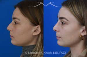 Photo of a patient before and after a procedure. Rhinoplasty to Straighten the Tip and Reduce Nasal Hump - before-and-after composite photo.
