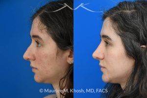 Photo of a patient before and after a procedure. Rhinoplasty for Droopy Tip and Small Hump - Patient sought septoplasty and rhinoplasty in our Manhattan office to address chronic nasal obstruction, deviated appearing bridge, a small dorsal hump, and sagging nasal tip. Surgery was performed through a closed approach (endo-nasal approach). The results show the one year result. She is ecstatic with the breathing and aesthetic results.