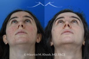 Photo of a patient before and after a procedure. Rhinoplasty for Droopy Tip and Small Hump - Patient sought septoplasty and rhinoplasty in our Manhattan office to address chronic nasal obstruction, deviated appearing bridge, a small dorsal hump, and sagging nasal tip. Surgery was performed through a closed approach (endo-nasal approach). The results show the one year result. She is ecstatic with the breathing and aesthetic results.