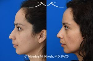 Photo of a patient before and after a procedure. Subtle Rhinoplasty to Elevate Tip and Improve Dorsal Hump - This lovely patient sought rhinoplasty consultation to achieve a subtle alteration in the shape of her nose. She wanted a slight lift of her nasal tip and reduction of the dorsal hump. She did not wish to have a significant change or an unnatural result. As you can see in the last two images in this series, the simulation results shown in the middle photos match the final results fairly closely. She is ecstatic with her results.