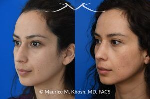 Photo of a patient before and after a procedure. Subtle Rhinoplasty to Elevate Tip and Improve Dorsal Hump - This lovely patient sought rhinoplasty consultation to achieve a subtle alteration in the shape of her nose. She wanted a slight lift of her nasal tip and reduction of the dorsal hump. She did not wish to have a significant change or an unnatural result. As you can see in the last two images in this series, the simulation results shown in the middle photos match the final results fairly closely. She is ecstatic with her results.