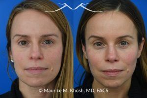 Photo of a patient before and after a procedure. Nasal Hump Reduction and Tip Narrow - This young lady had septum deviation which affected her breathing and caused asymmetry of her nostrils. She wanted to smooth a small nasal hump and narrow her tip in a conservative manner. The last two images show her pre op profile (on the left), the computer simulation (in the middle), and the final results (on the right). 