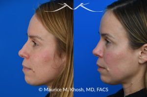 Photo of a patient before and after a procedure. Nasal Hump Reduction and Tip Narrow - This young lady had septum deviation which affected her breathing and caused asymmetry of her nostrils. She wanted to smooth a small nasal hump and narrow her tip in a conservative manner. The last two images show her pre op profile (on the left), the computer simulation (in the middle), and the final results (on the right). 