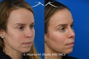 Photo of a patient before and after a procedure. Nasal Hump Reduction and Tip Narrow - This young lady had septum deviation which affected her breathing and caused asymmetry of her nostrils. She wanted to smooth a small nasal hump and narrow her tip in a conservative manner. The last two images show her pre op profile (on the left), the computer simulation (in the middle), and the final results (on the right). 