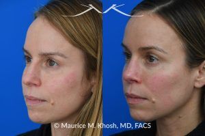 Photo of a patient before and after a procedure. Nasal Hump Reduction and Tip Narrow - This young lady had septum deviation which affected her breathing and caused asymmetry of her nostrils. She wanted to smooth a small nasal hump and narrow her tip in a conservative manner. The last two images show her pre op profile (on the left), the computer simulation (in the middle), and the final results (on the right). 