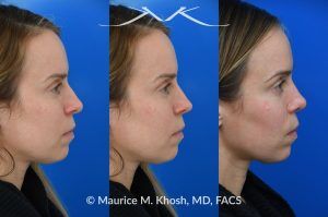 Photo of a patient before and after a procedure. Nasal Hump Reduction and Tip Narrow - This young lady had septum deviation which affected her breathing and caused asymmetry of her nostrils. She wanted to smooth a small nasal hump and narrow her tip in a conservative manner. The last two images show her pre op profile (on the left), the computer simulation (in the middle), and the final results (on the right). 