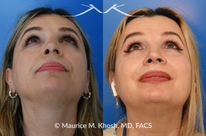 Photo of a patient before and after a procedure. Rhinoplasty for Droopy and Twisted Tip and Dorsum Deviation to the Right - This delightful patient wanted to address a twisted and droopy nasal tip. An open approach was used to reduce the nasal hump, elevate and refine the nasal tip. She is ecstatic with the results of her rhinoplasty. 
