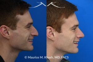 Photo of a patient before and after a procedure. Rhinoplasty for Long and Droopy Tip and Nasal Hump - This young professional wanted improved breathing and enhancement of his nasal appearance. An open rhinoplasty  was used to lower the nasal bridge and narrow and elevate the nasal tip.
