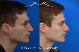 Photo of a patient before and after a procedure. Rhinoplasty for Long and Droopy Tip and Nasal Hump - This young professional wanted improved breathing and enhancement of his nasal appearance. An open rhinoplasty  was used to lower the nasal bridge and narrow and elevate the nasal tip.