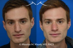 Photo of a patient before and after a procedure. Rhinoplasty for Long and Droopy Tip and Nasal Hump - This young professional wanted improved breathing and enhancement of his nasal appearance. An open rhinoplasty  was used to lower the nasal bridge and narrow and elevate the nasal tip.