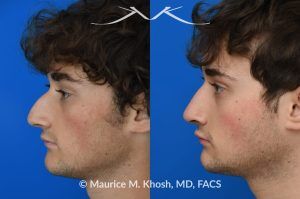 Photo of a patient before and after a procedure.  Rhinoplasty for Nasal Obstruction, Large Nasal Hump, and Droopy Nasal Tip - This young patient had a severely deviated septum which caused nasal obstruction. During an open rhinoplasty, the septum deviation was addressed. The nasal hump was reduced while preserving his overall facial appearance. The droopy nasal hump was corrected with the use of septo-columellar sutures. A small cartilage graft was applied to the excessively deep naso-forntal angle (radix). 