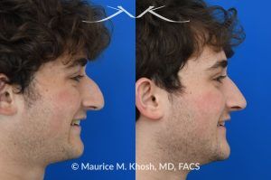 Photo of a patient before and after a procedure.  Rhinoplasty for Nasal Obstruction, Large Nasal Hump, and Droopy Nasal Tip - This young patient had a severely deviated septum which caused nasal obstruction. During an open rhinoplasty, the septum deviation was addressed. The nasal hump was reduced while preserving his overall facial appearance. The droopy nasal hump was corrected with the use of septo-columellar sutures. A small cartilage graft was applied to the excessively deep naso-forntal angle (radix). 