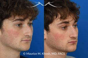 Photo of a patient before and after a procedure.  Rhinoplasty for Nasal Obstruction, Large Nasal Hump, and Droopy Nasal Tip - This young patient had a severely deviated septum which caused nasal obstruction. During an open rhinoplasty, the septum deviation was addressed. The nasal hump was reduced while preserving his overall facial appearance. The droopy nasal hump was corrected with the use of septo-columellar sutures. A small cartilage graft was applied to the excessively deep naso-forntal angle (radix). 