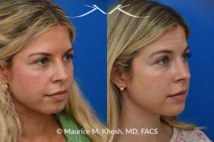 Photo of a patient before and after a procedure. Subtle Rhinoplasty for Dorsum Deviation to the Right Side - This wonderful patient had a minor imperfection in her nose. The nasal dorsum deviated to the right side and she had a very minor bony hump. I used a closed rhinoplasty approach. The nasal hump was shaved. The dorsum deviation was addressed with spreader-graft application to the left side.