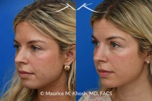 Photo of a patient before and after a procedure. Subtle Rhinoplasty for Dorsum Deviation to the Right Side - This wonderful patient had a minor imperfection in her nose. The nasal dorsum deviated to the right side and she had a very minor bony hump. I used a closed rhinoplasty approach. The nasal hump was shaved. The dorsum deviation was addressed with spreader-graft application to the left side.