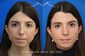 Photo of a patient before and after a procedure. Rhinoplasty for Dorsal Hump - This young patient wished to eliminate the hump in the bridge of her nose. A closed-approach rhinoplasty allowed removal of the nasal hump and provided her a beautiful and natural slope to the nasal bridge. She is delighted with the results of her nose job.