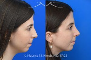 Photo of a patient before and after a procedure. Rhinoplasty for Dorsal Hump - This young patient wished to eliminate the hump in the bridge of her nose. A closed-approach rhinoplasty allowed removal of the nasal hump and provided her a beautiful and natural slope to the nasal bridge. She is delighted with the results of her nose job.