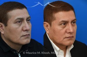 Photo of a patient before and after a procedure. Rhinoplasty for Droopy TIp - This gentleman had suffered a nasal fracture and noted breathing obstruction and poor nasal tip support which gave his nasal tip a droopy appearance. Septoplast was performed to restore his breathing. An open rhinoplasty approach was used to place bilateral septum extension grafts and a cap graft to improve the position and contour of the nose. He is ecstatic about his breathing capacity and nasal appearance following his rhinoplasty in New York.