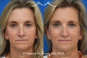 Photo of a patient before and after a procedure. Upper Blepharoplasty and Rhinoplasty - Upper blepharoplasty and rhinoplasty to decrease nasal tip projection. 