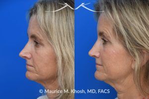 Photo of a patient before and after a procedure. Upper Blepharoplasty and Rhinoplasty - Upper blepharoplasty and rhinoplasty to decrease nasal tip projection. 