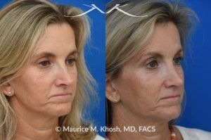 Photo of a patient before and after a procedure. Upper Blepharoplasty and Rhinoplasty - Upper blepharoplasty and rhinoplasty to decrease nasal tip projection. 