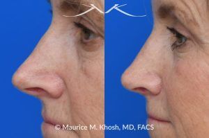 Photo of a patient before and after a procedure. Upper Blepharoplasty and Rhinoplasty - Upper blepharoplasty and rhinoplasty to decrease nasal tip projection. 