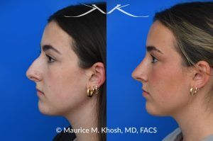 Photo of a patient before and after a procedure. Rhinoplasty to Improve Breathing, Correct Nasal Deviation, and Reduce Nasal Hump  - before-and-after composite photo.