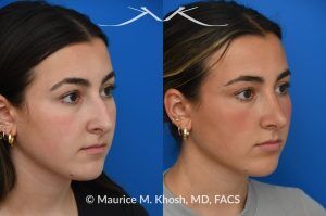 Photo of a patient before and after a procedure. Rhinoplasty to Improve Breathing, Correct Nasal Deviation, and Reduce Nasal Hump  - before-and-after composite photo.