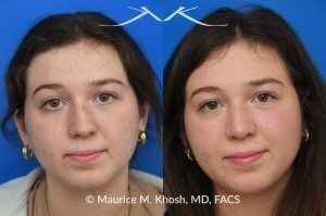 Photo of a patient before and after a procedure. Rhinoplasty for Nasal Bridge Deviation and Droopy Tip - This young patient had a nasal hump, a deviated nose on the front view, and lacked nasal tip definition. An open rhinoplasty was performed to address all areas of concern. She is extremely happy with her final results.