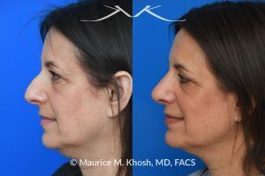 Photo of a patient before and after a procedure. Rhinoplasty for Nasal Hump and Droopy Tip - before-and-after composite photo.