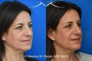 Photo of a patient before and after a procedure. Rhinoplasty for Nasal Hump and Droopy Tip - before-and-after composite photo.