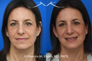 Photo of a patient before and after a procedure. Rhinoplasty for Nasal Hump and Droopy Tip - before-and-after composite photo.