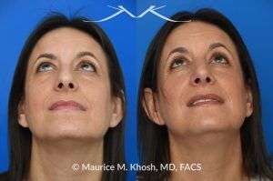 Photo of a patient before and after a procedure. Rhinoplasty for Nasal Hump and Droopy Tip - before-and-after composite photo.