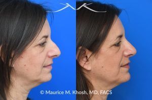 Photo of a patient before and after a procedure. Rhinoplasty for Nasal Hump and Droopy Tip - before-and-after composite photo.