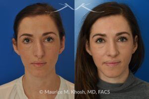 Photo of a patient before and after a procedure. Rhinoplasty for Crooked Nose, Nasal Hump, and Hanging Columella Correction - This amazing 28 year-old had sustained a nose fracture at age eight which left her nose crooked to the left. She had severe nasal obstruction. Rhinoplasty though the open approach allowed correction of her crooked nose, smoothing of nasal hump, and push back of the hanging columella which was most notable on profile view.