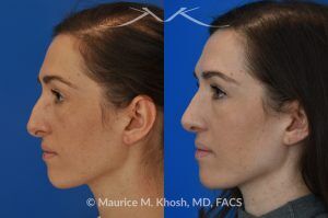 Photo of a patient before and after a procedure. Rhinoplasty for Crooked Nose, Nasal Hump, and Hanging Columella Correction - This amazing 28 year-old had sustained a nose fracture at age eight which left her nose crooked to the left. She had severe nasal obstruction. Rhinoplasty though the open approach allowed correction of her crooked nose, smoothing of nasal hump, and push back of the hanging columella which was most notable on profile view.