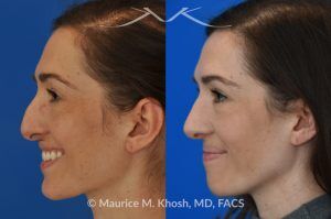 Photo of a patient before and after a procedure. Rhinoplasty for Crooked Nose, Nasal Hump, and Hanging Columella Correction - This amazing 28 year-old had sustained a nose fracture at age eight which left her nose crooked to the left. She had severe nasal obstruction. Rhinoplasty though the open approach allowed correction of her crooked nose, smoothing of nasal hump, and push back of the hanging columella which was most notable on profile view.