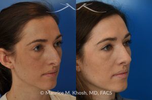 Photo of a patient before and after a procedure. Rhinoplasty for Crooked Nose, Nasal Hump, and Hanging Columella Correction - This amazing 28 year-old had sustained a nose fracture at age eight which left her nose crooked to the left. She had severe nasal obstruction. Rhinoplasty though the open approach allowed correction of her crooked nose, smoothing of nasal hump, and push back of the hanging columella which was most notable on profile view.