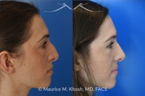 Photo of a patient before and after a procedure. Rhinoplasty for Crooked Nose, Nasal Hump, and Hanging Columella Correction - This amazing 28 year-old had sustained a nose fracture at age eight which left her nose crooked to the left. She had severe nasal obstruction. Rhinoplasty though the open approach allowed correction of her crooked nose, smoothing of nasal hump, and push back of the hanging columella which was most notable on profile view.