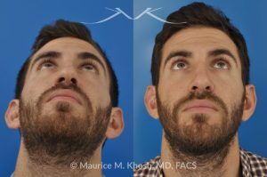 Photo of a patient before and after a procedure. Rhinoplasty to Correct Crooked Nose with Droopy Tip - before-and-after composite photo.