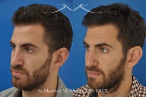 Photo of a patient before and after a procedure. Rhinoplasty to Correct Crooked Nose with Droopy Tip - before-and-after composite photo.