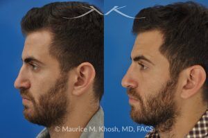 Photo of a patient before and after a procedure. Rhinoplasty to Correct Crooked Nose with Droopy Tip - before-and-after composite photo.