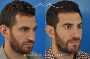 Photo of a patient before and after a procedure. Rhinoplasty to Correct Crooked Nose with Droopy Tip - before-and-after composite photo.